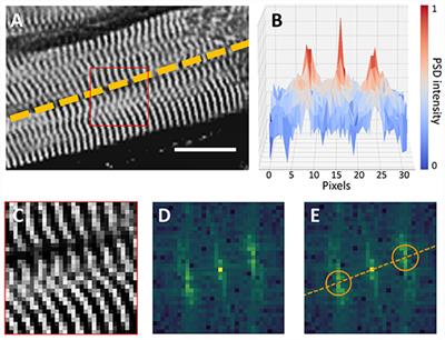 Quantification of Myocyte Disarray in Human Cardiac Tissue